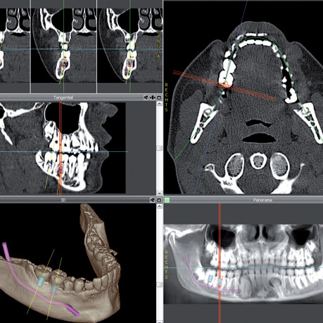 Digitale Volumentomographie bietet dem Behandlerteam den aktuell sichersten und höchsten Standard in der Röntgendiagnostik